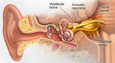 neurinom acustic