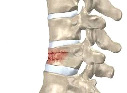 vertebroplastie 1