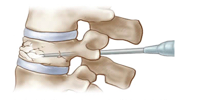 vertebroplastie 2