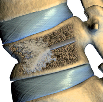 vertebroplastie 3