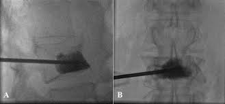 vertebroplastie 4